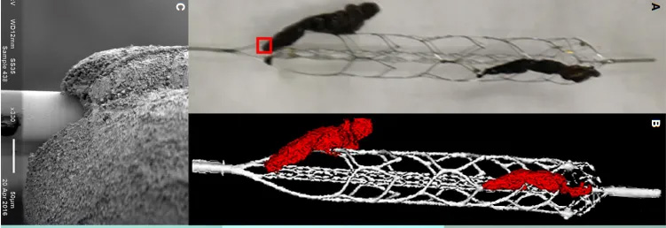 急性虚血性脳卒中患者における血栓とステントリトリーバーの相互作用の高解像度画像